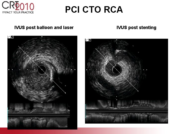 PCI CTO RCA IVUS post balloon and laser IVUS post stenting 