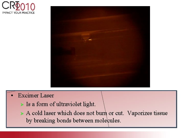  • Excimer Laser Ø Is a form of ultraviolet light. Ø A cold