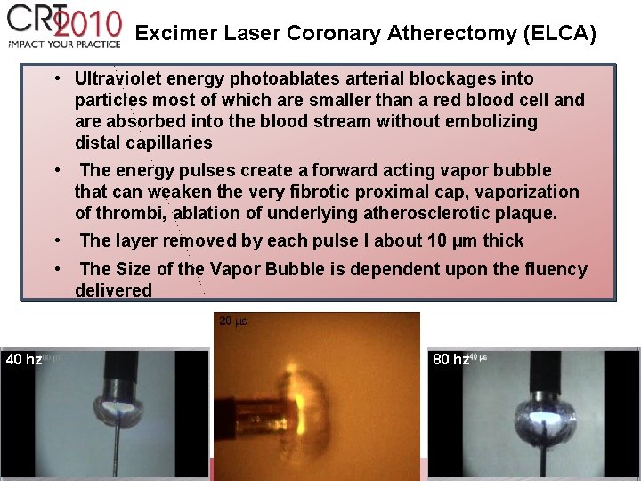 Excimer Laser Coronary Atherectomy (ELCA) • Ultraviolet energy photoablates arterial blockages into particles most