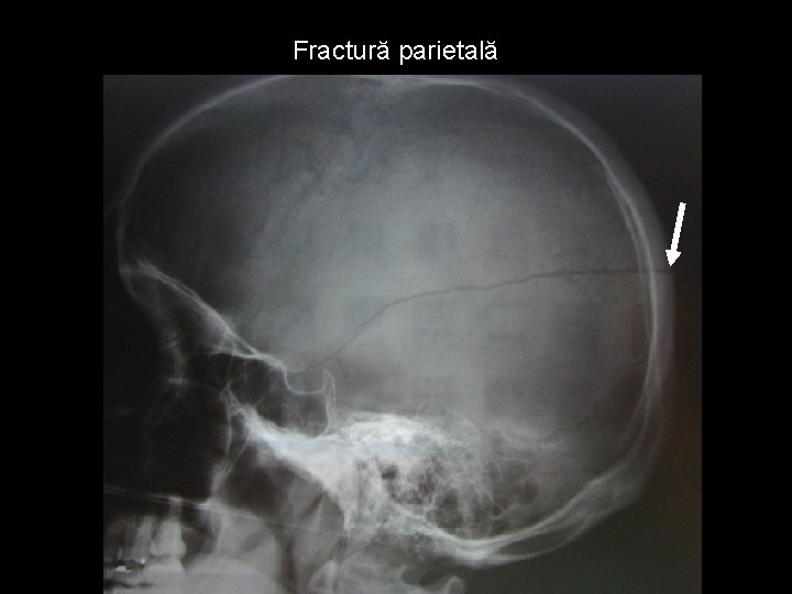 Fractură parietală Fractură parietală