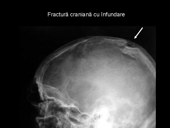 Fractură craniană cu înfundare Fractură craniană cu înfundare