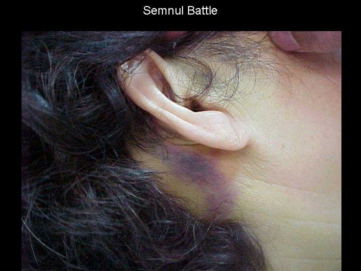 Semnul Battle Semnul Battle