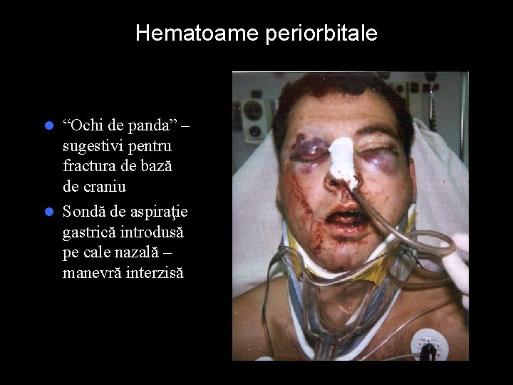 Hematoame periorbitale “Ochi de panda” – sugestivi pentru fractura de bază de craniu l Hematoame periorbitale “Ochi de panda” – sugestivi pentru fractura de bază de craniu l
