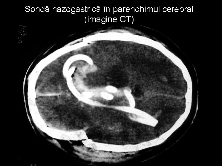 Sondă nazogastrică în parenchimul cerebral (imagine CT) Sondă nazogastrică în parenchimul cerebral (imagine CT)