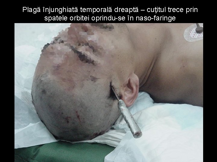 Plagă înjunghiată temporală dreaptă – cuţitul trece prin spatele orbitei oprindu-se în naso-faringe Plagă înjunghiată temporală dreaptă – cuţitul trece prin spatele orbitei oprindu-se în naso-faringe