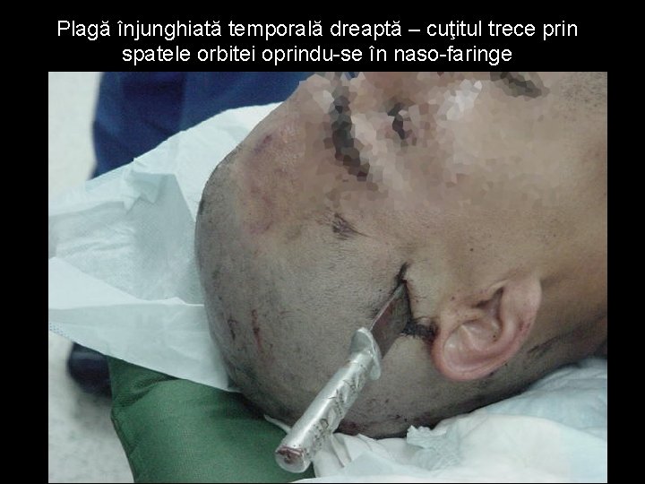 Plagă înjunghiată temporală dreaptă – cuţitul trece prin spatele orbitei oprindu-se în naso-faringe Plagă înjunghiată temporală dreaptă – cuţitul trece prin spatele orbitei oprindu-se în naso-faringe
