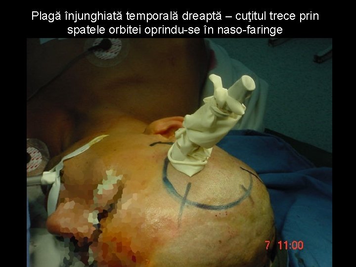 Plagă înjunghiată temporală dreaptă – cuţitul trece prin spatele orbitei oprindu-se în naso-faringe Plagă înjunghiată temporală dreaptă – cuţitul trece prin spatele orbitei oprindu-se în naso-faringe