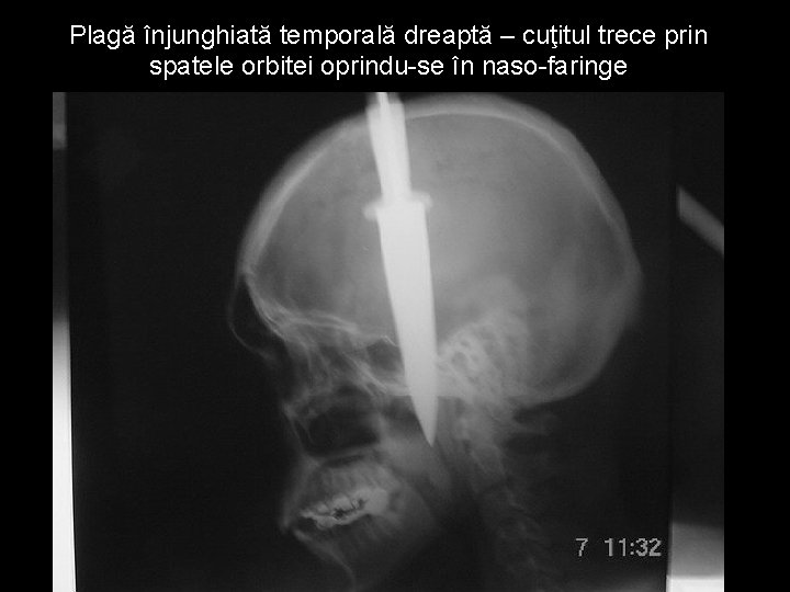 Plagă înjunghiată temporală dreaptă – cuţitul trece prin spatele orbitei oprindu-se în naso-faringe Plagă înjunghiată temporală dreaptă – cuţitul trece prin spatele orbitei oprindu-se în naso-faringe