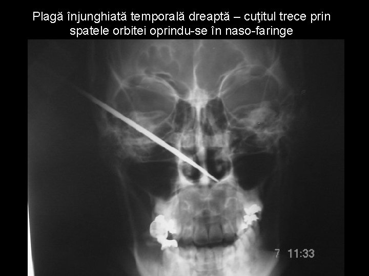 Plagă înjunghiată temporală dreaptă – cuţitul trece prin spatele orbitei oprindu-se în naso-faringe Plagă înjunghiată temporală dreaptă – cuţitul trece prin spatele orbitei oprindu-se în naso-faringe