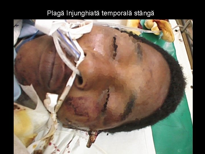Plagă înjunghiată temporală stângă Plagă înjunghiată temporală stângă
