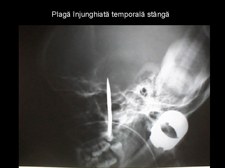 Plagă înjunghiată temporală stângă Plagă înjunghiată temporală stângă