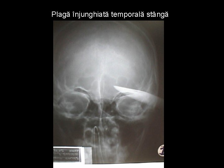 Plagă înjunghiată temporală stângă Plagă înjunghiată temporală stângă