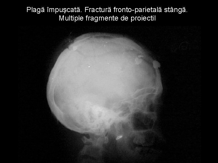 Plagă împuşcată. Fractură fronto-parietală stângă. Multiple fragmente de proiectil Plagă împuşcată. Fractură fronto-parietală stângă. Multiple fragmente de proiectil