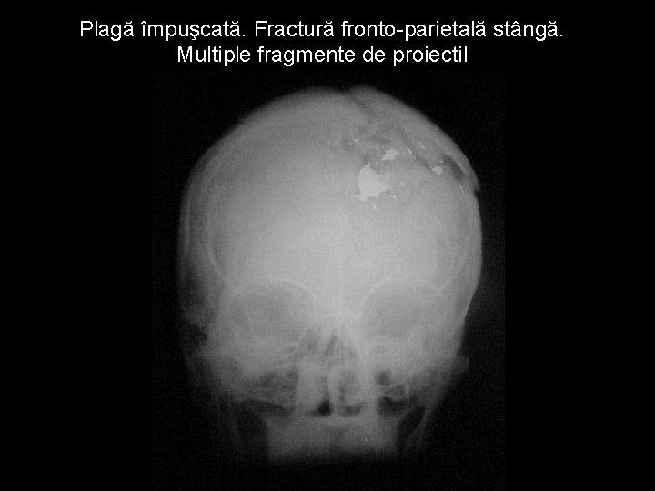 Plagă împuşcată. Fractură fronto-parietală stângă. Multiple fragmente de proiectil Plagă împuşcată. Fractură fronto-parietală stângă. Multiple fragmente de proiectil