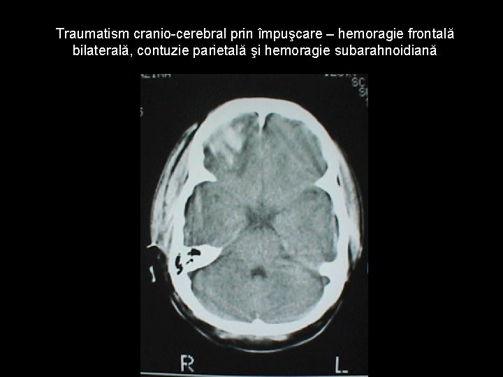 Traumatism cranio-cerebral prin împuşcare – hemoragie frontală bilaterală, contuzie parietală şi hemoragie subarahnoidiană Traumatism cranio-cerebral prin împuşcare – hemoragie frontală bilaterală, contuzie parietală şi hemoragie subarahnoidiană