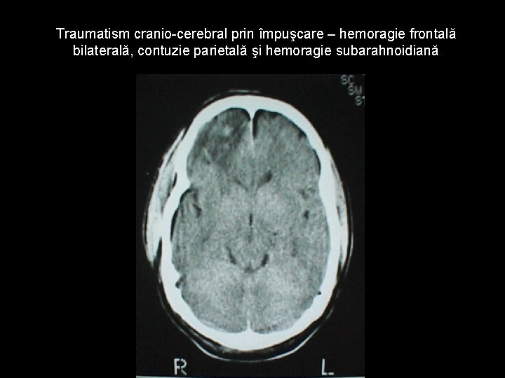 Traumatism cranio-cerebral prin împuşcare – hemoragie frontală bilaterală, contuzie parietală şi hemoragie subarahnoidiană Traumatism cranio-cerebral prin împuşcare – hemoragie frontală bilaterală, contuzie parietală şi hemoragie subarahnoidiană