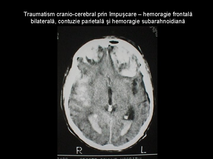 Traumatism cranio-cerebral prin împuşcare – hemoragie frontală bilaterală, contuzie parietală şi hemoragie subarahnoidiană Traumatism cranio-cerebral prin împuşcare – hemoragie frontală bilaterală, contuzie parietală şi hemoragie subarahnoidiană