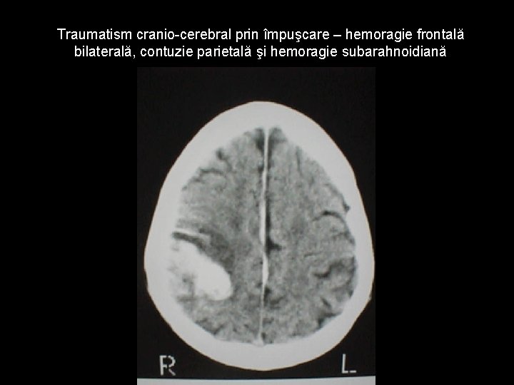 Traumatism cranio-cerebral prin împuşcare – hemoragie frontală bilaterală, contuzie parietală şi hemoragie subarahnoidiană Traumatism cranio-cerebral prin împuşcare – hemoragie frontală bilaterală, contuzie parietală şi hemoragie subarahnoidiană