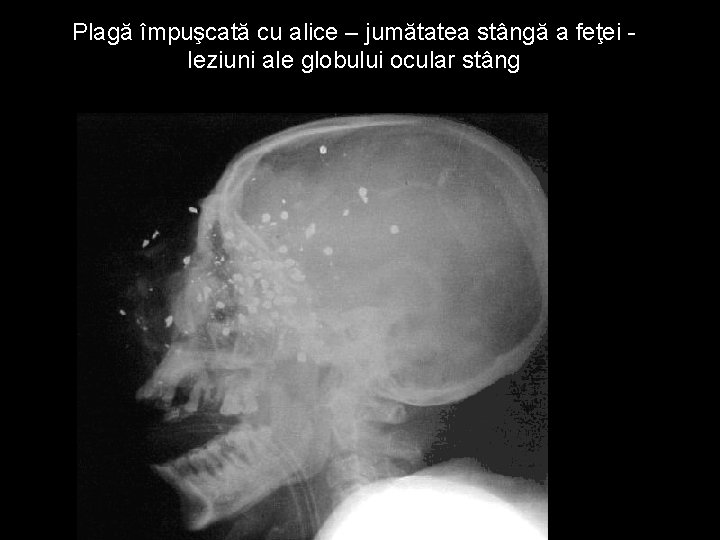 Plagă împuşcată cu alice – jumătatea stângă a feţei leziuni ale globului ocular stâng Plagă împuşcată cu alice – jumătatea stângă a feţei leziuni ale globului ocular stâng