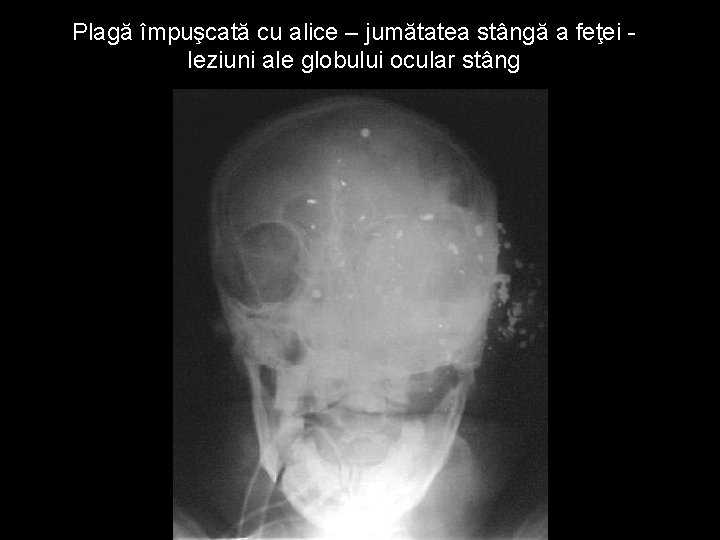 Plagă împuşcată cu alice – jumătatea stângă a feţei leziuni ale globului ocular stâng Plagă împuşcată cu alice – jumătatea stângă a feţei leziuni ale globului ocular stâng