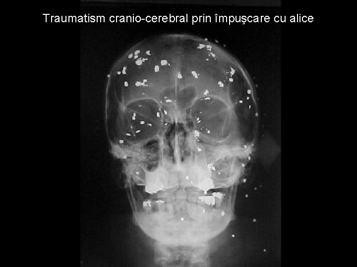 Traumatism cranio-cerebral prin împuşcare cu alice Traumatism cranio-cerebral prin împuşcare cu alice
