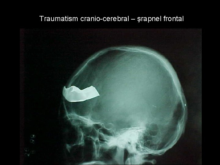 Traumatism cranio-cerebral – şrapnel frontal Traumatism cranio-cerebral – şrapnel frontal