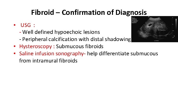 Fibroid – Confirmation of Diagnosis • USG : - Well defined hypoechoic lesions -
