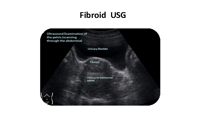 Fibroid USG 