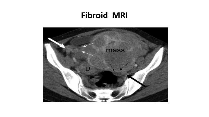 Fibroid MRI 