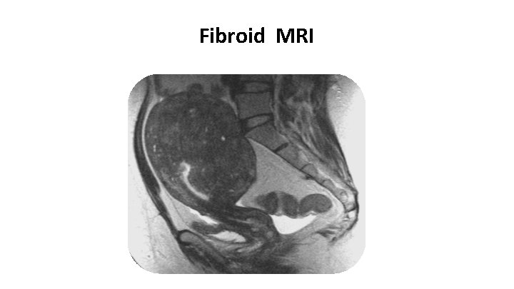 Fibroid MRI 