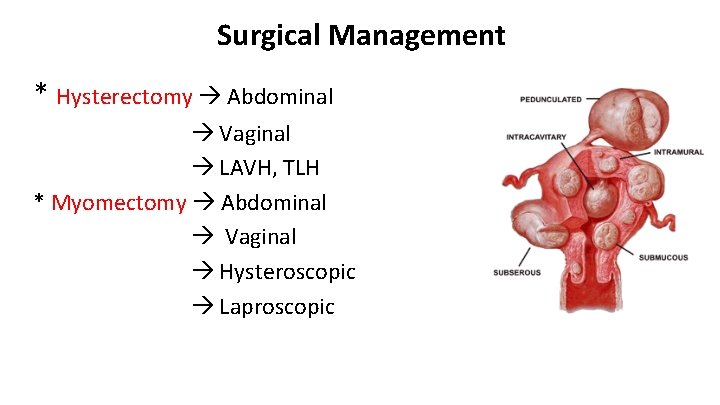 Surgical Management * Hysterectomy Abdominal Vaginal LAVH, TLH * Myomectomy Abdominal Vaginal Hysteroscopic Laproscopic
