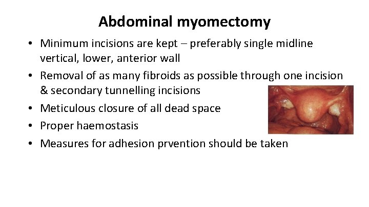 Abdominal myomectomy • Minimum incisions are kept – preferably single midline vertical, lower, anterior