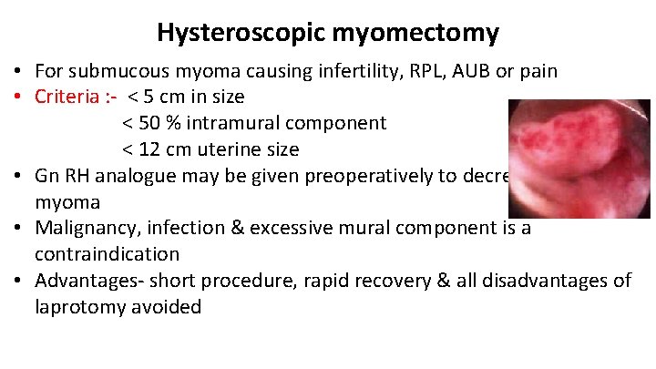 Hysteroscopic myomectomy • For submucous myoma causing infertility, RPL, AUB or pain • Criteria