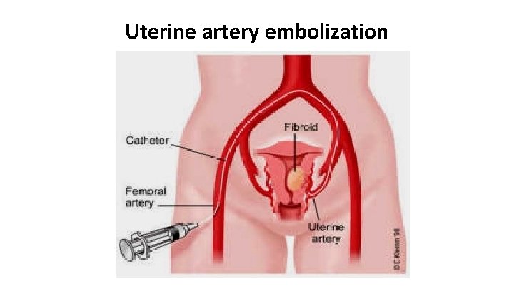 Uterine artery embolization 