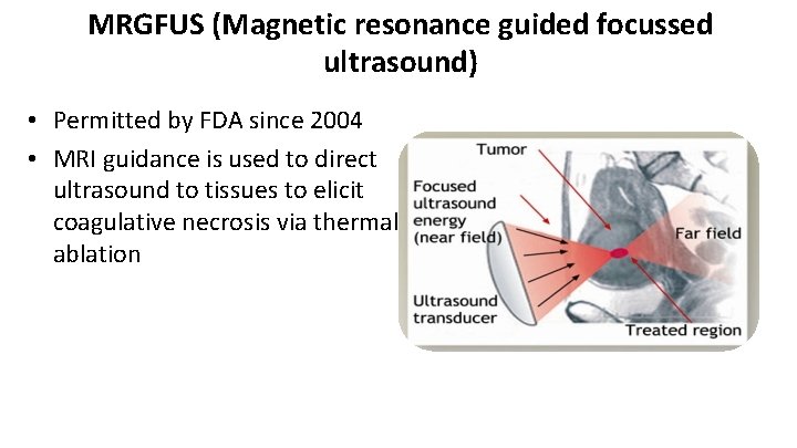 MRGFUS (Magnetic resonance guided focussed ultrasound) • Permitted by FDA since 2004 • MRI