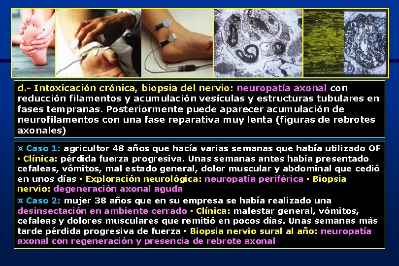 d. - Intoxicación crónica, biopsia del nervio: neuropatía axonal con reducción filamentos y acumulación