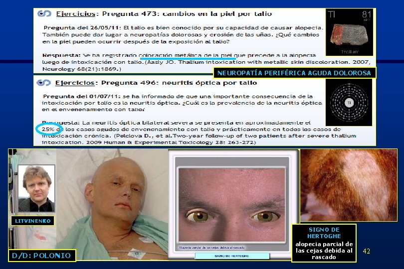 NEUROPATÍA PERIFÉRICA AGUDA DOLOROSA LITVINENKO D/D: POLONIO SIGNO DE HERTOGHE alopecia parcial de las