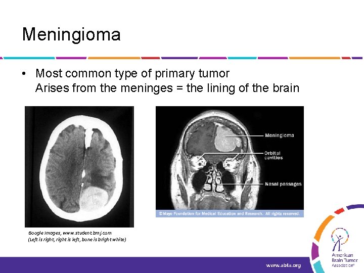 Meningioma • Most common type of primary tumor Arises from the meninges = the