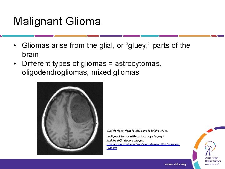 Malignant Glioma • Gliomas arise from the glial, or “gluey, ” parts of the