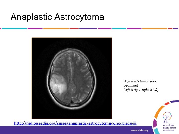 Anaplastic Astrocytoma High grade tumor, pretreatment (Left is right, right is left) http: //radiopaedia.