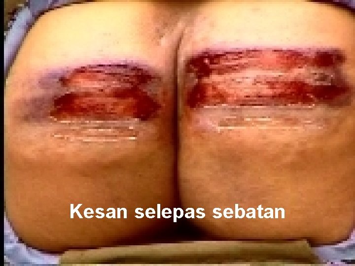 Kesan selepas sebatan 