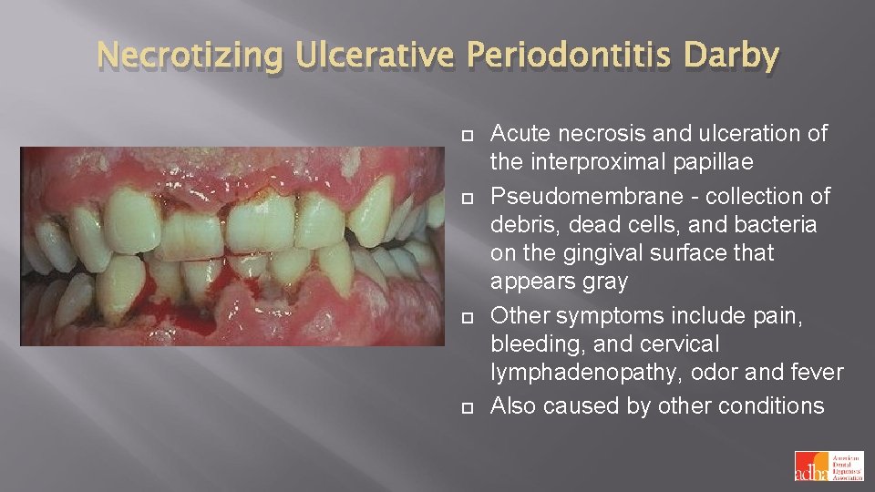 Necrotizing Ulcerative Periodontitis Darby Acute necrosis and ulceration of the interproximal papillae Pseudomembrane -