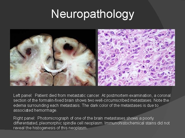 Neuropathology Left panel: Patient died from metastatic cancer. At postmortem examination, a coronal section