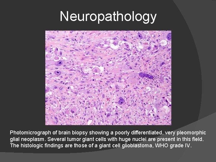 Neuropathology Photomicrograph of brain biopsy showing a poorly differentiated, very pleomorphic glial neoplasm. Several