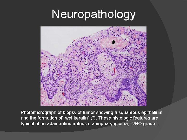 Neuropathology Photomicrograph of biopsy of tumor showing a squamous epithelium and the formation of