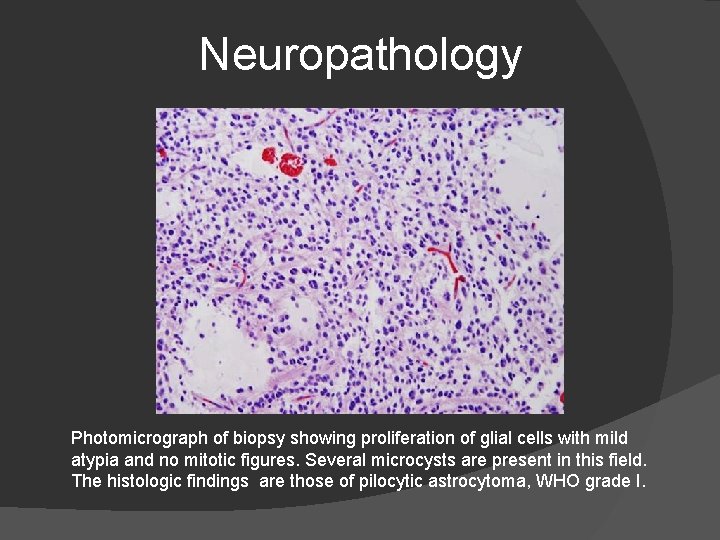 Neuropathology Photomicrograph of biopsy showing proliferation of glial cells with mild atypia and no