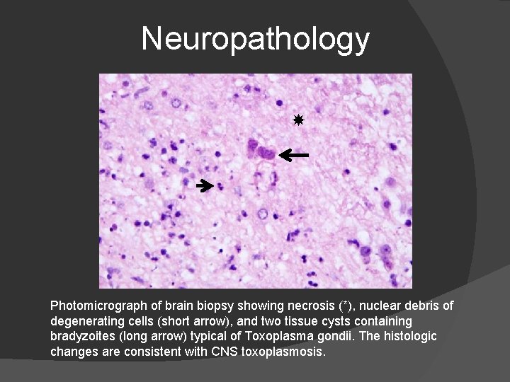 Neuropathology Photomicrograph of brain biopsy showing necrosis (*), nuclear debris of degenerating cells (short