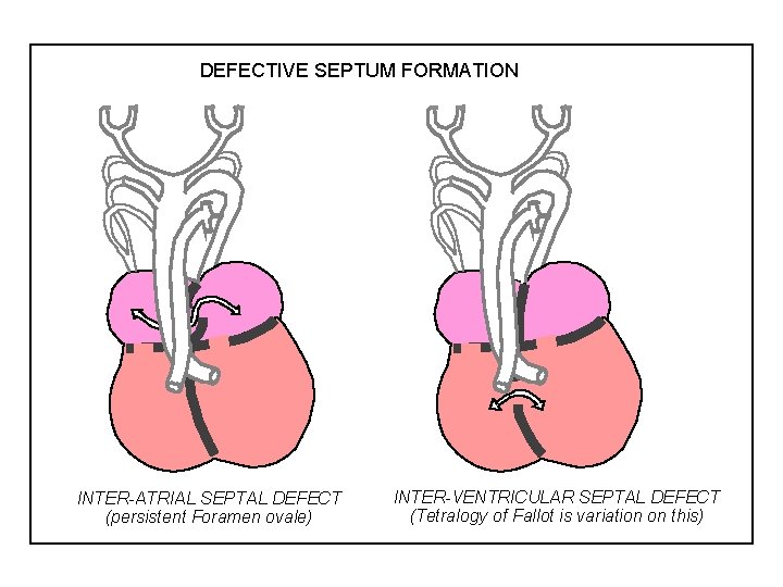 DEFECTIVE SEPTUM FORMATION INTER-ATRIAL SEPTAL DEFECT (persistent Foramen ovale) INTER-VENTRICULAR SEPTAL DEFECT (Tetralogy of