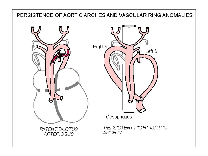 PERSISTENCE OF AORTIC ARCHES AND VASCULAR RING ANOMALIES Right 4 Left 6 Oesophagus PATENT