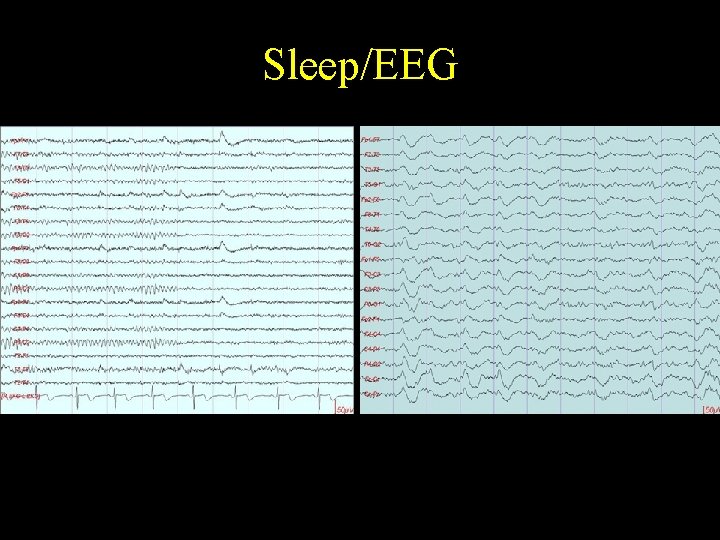 Sleep/EEG 